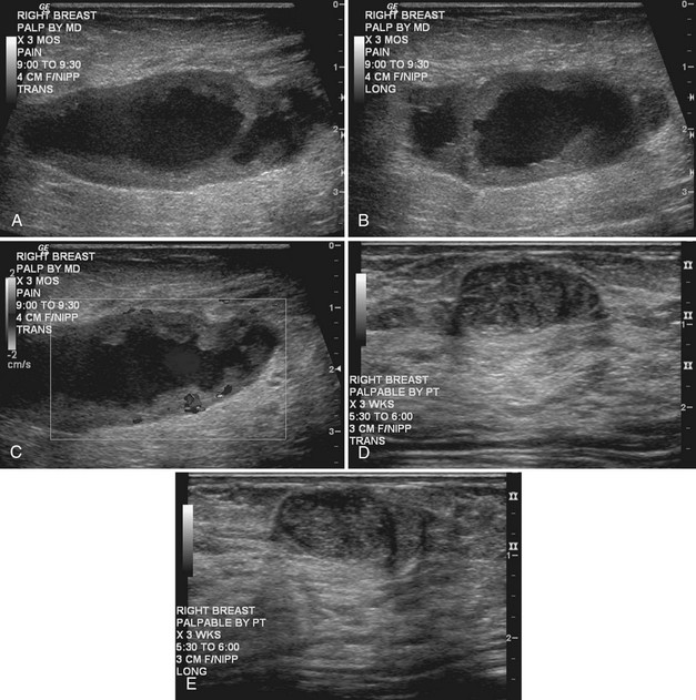 Breast Cyst Ultrasound image.