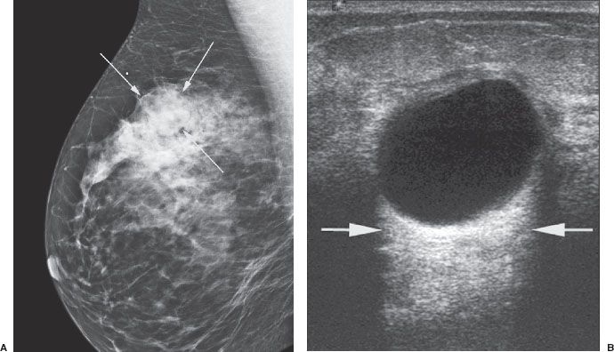 Breast Cyst Mammogram