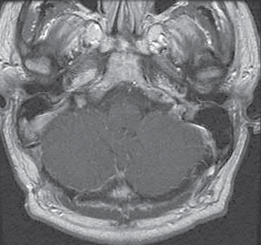 Vagal schwannoma – postoperative radiosurgery for residual tumor ...