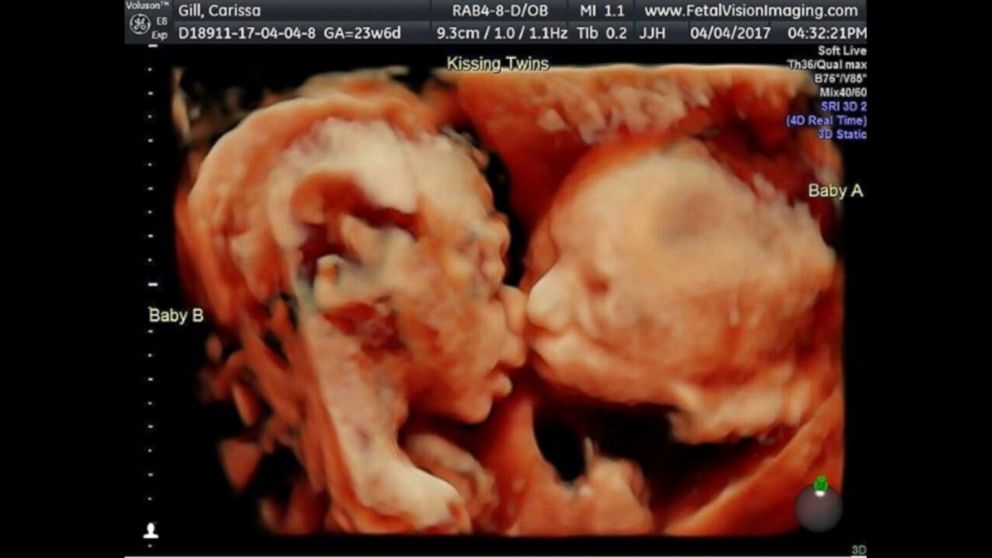 Pregnant With Twins Ultrasound