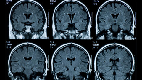 La «popularité» du cerveau, de son activité et des neurosciences donne lieu à des raccourcis, fausses informations, voire des contre-vérités.