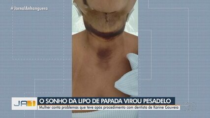 Paciente denuncia hematomas após lipo de papada em clínica de Goiânia