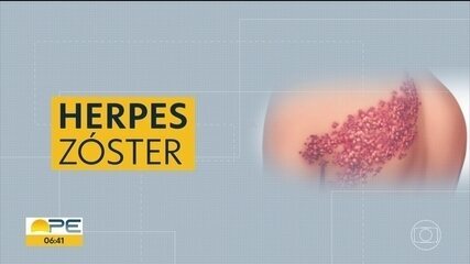 Especialista explica sintomas e tratamento da herpes-zóster