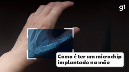 Como é ter um microchip implantado na mão