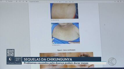 Problemas causados pela Chikungunya podem durar meses