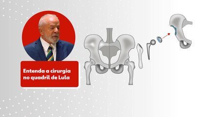 Entenda a cirurgia no quadril de Lula