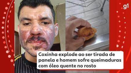 Coxinha explode ao ser tirada de panela e homem sofre queimaduras com óleo quente no rosto