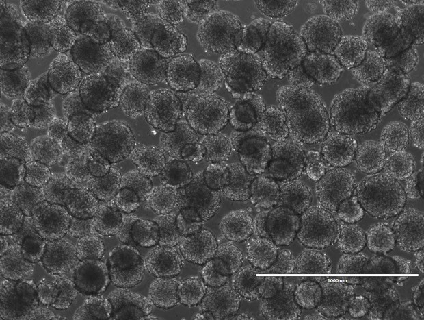 'Minicérebros' foram criados em laboratório a partir de células da pele de pacientes com a síndrome do MECP2