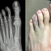 4th toe is bruised, swollen and painful despite negative Xray