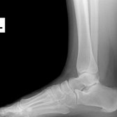 X-rays are unreliable when it comes to fascia tears or stress fractures