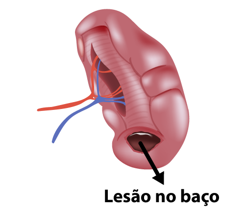 Ilustração de um baço com lesão.