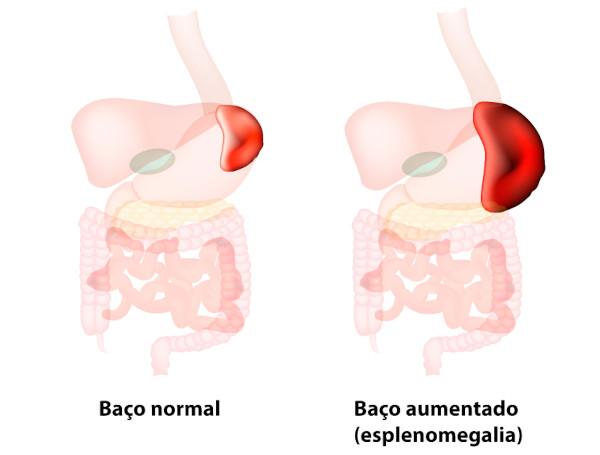 Ilustração representando a esplenomegalia, a condição em que o baço aumenta de tamanho.