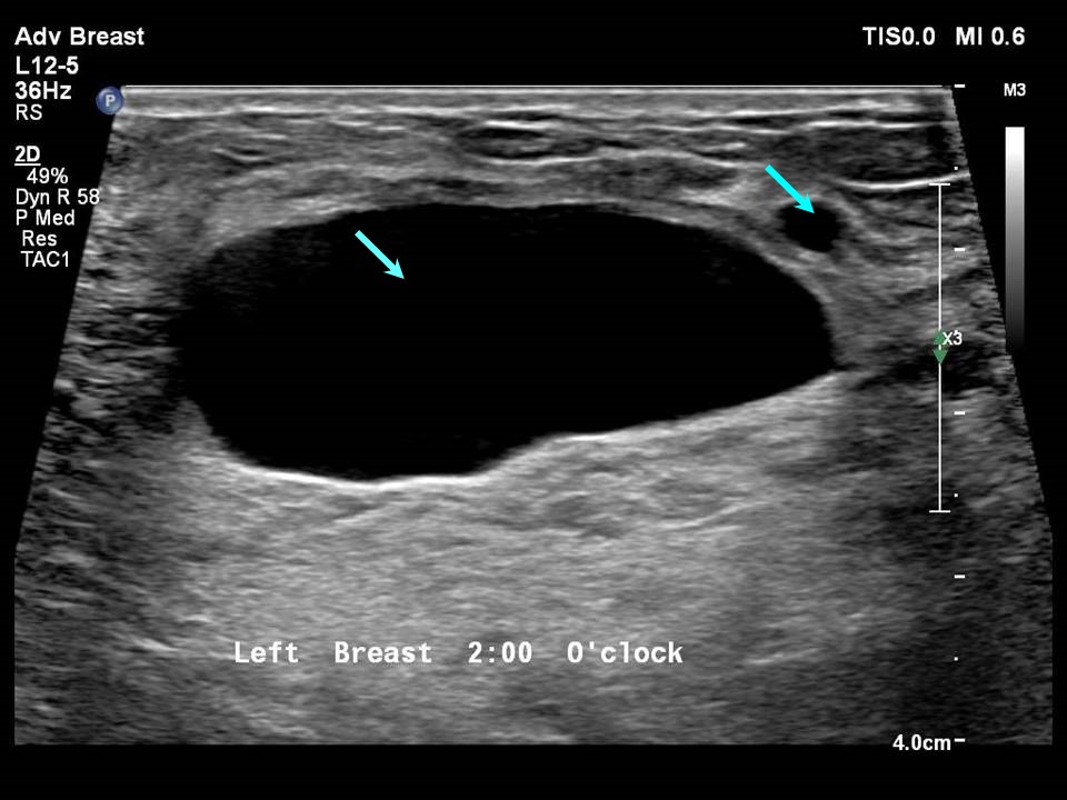 What Does A Dvt Look Like On An Ultrasound at Carlos Mildred blog