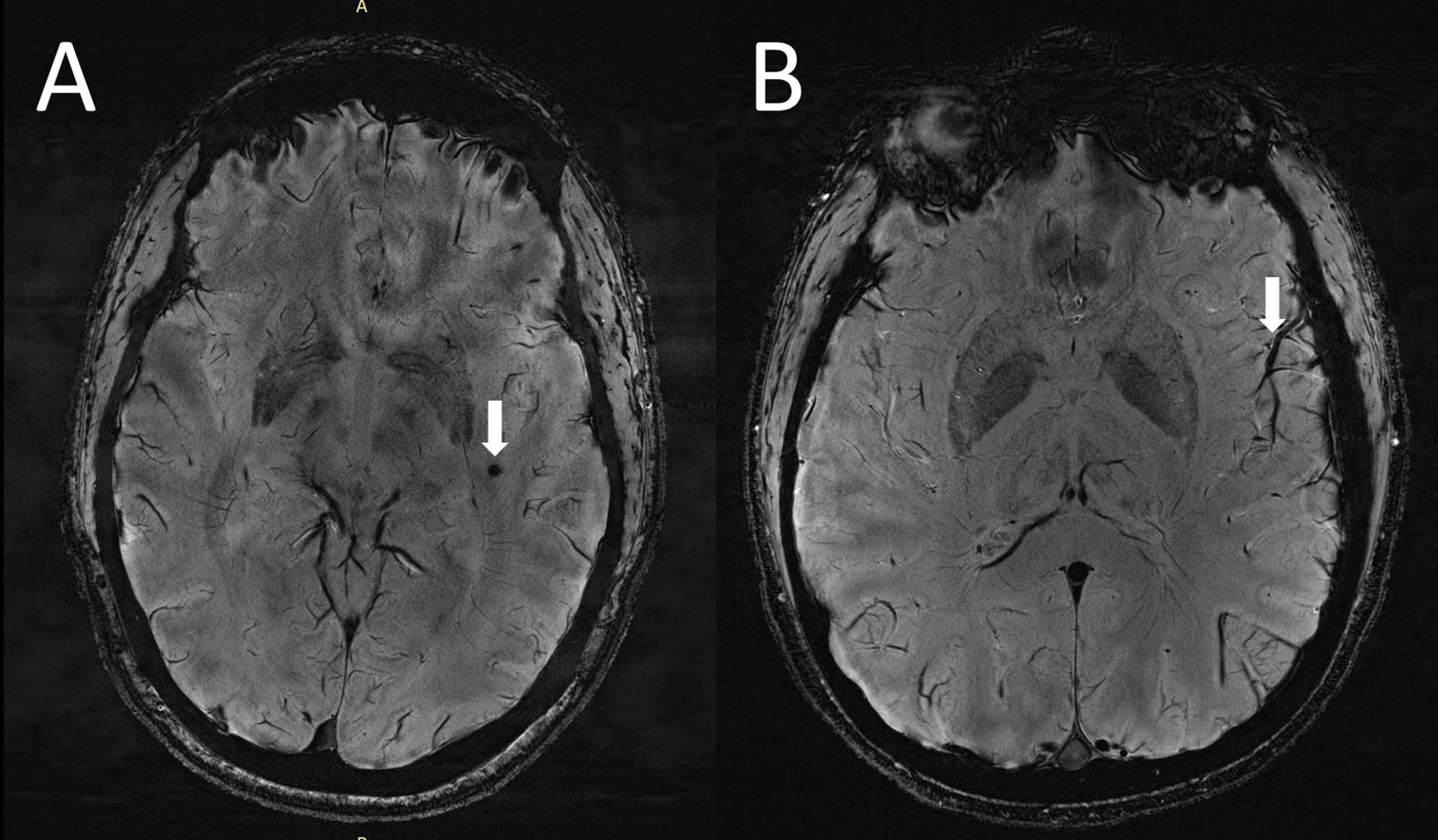 Centrum Semiovale Mri