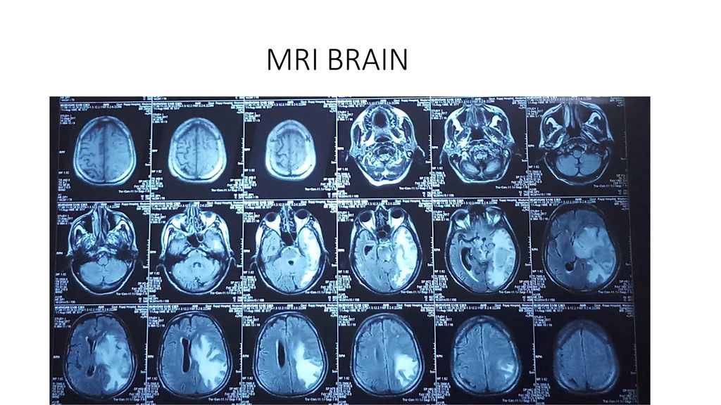 INTERESTING CASE OF CNS TUBERCULOSIS - ppt download