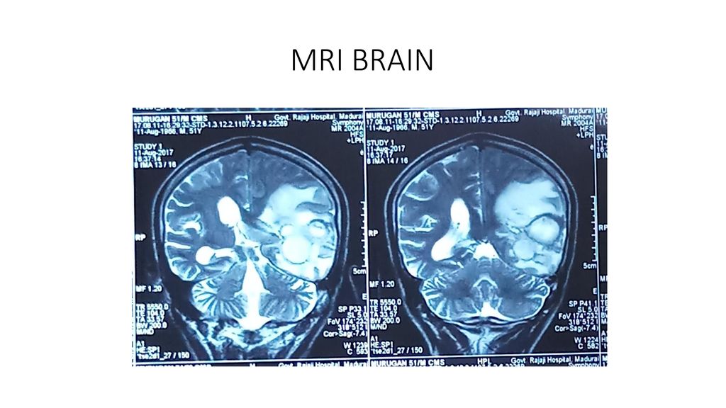 INTERESTING CASE OF CNS TUBERCULOSIS - ppt download