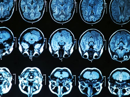 MRI scan of the human brain