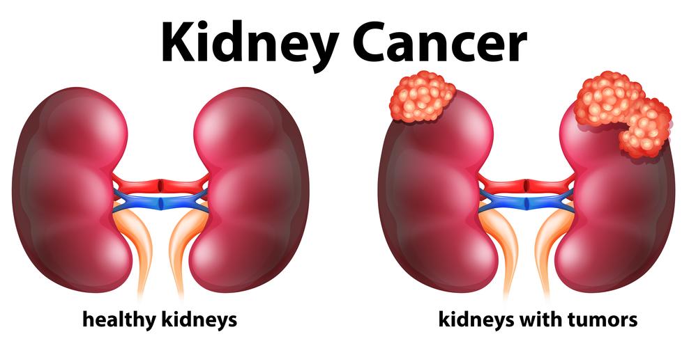 Diagram showing kidney cancer in human vector