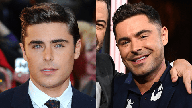 Zac Efron Before and After Jaw Surgery