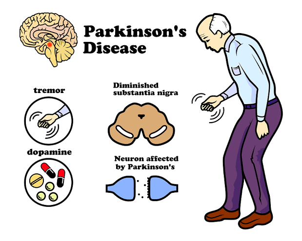 Parkinson's Disease- Symptoms and treatment — Teletype