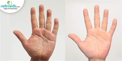 What Causes Skin On The Hands To Peel? Causes, Symptoms, Underlying Condition And Treatment