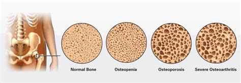 You and Your Bone Density