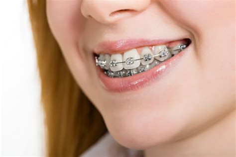 Traditional Metal Braces | Charlotte Orthodontist | Crown Point Orthodontics