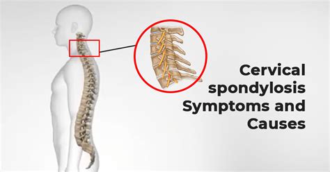 Cervical Spondylosis Symptoms and Causes | ASPC Manipulation Therapy