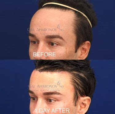 | HAIRLINE LOWERING SURGERY | Forehead reduction surgery, Forehead reduction, Male hairline