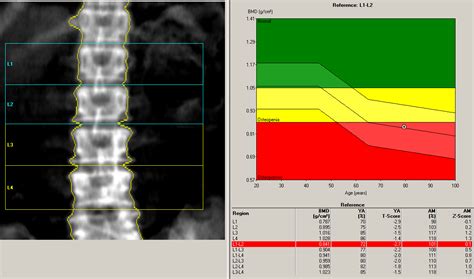 Bone Densitometry - Robin K Dore MD, Inc.