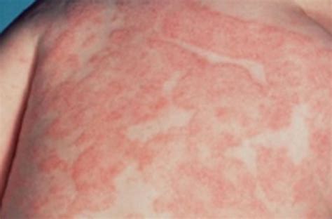 Skin Fungal Rash