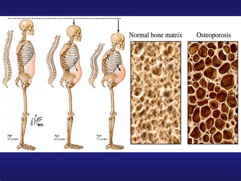 What is normal bone density range: Bone Density Test, Osteoporosis Screening & T-score ...