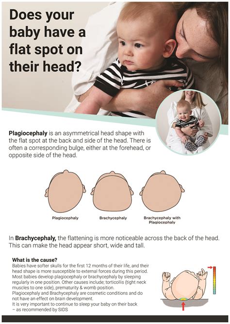 How To Correct Flat Spot On Baby Head - Baby Viewer