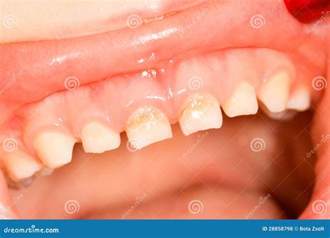 Milk Teeth Royalty Free Stock Photos - Image: 28858798