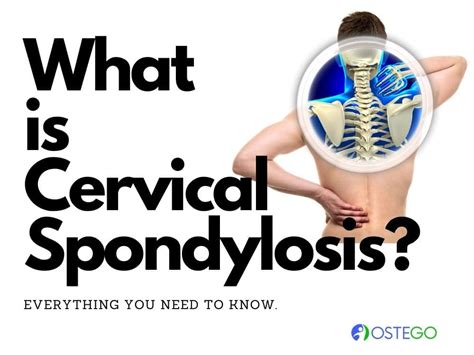 What Are The Symptoms Of And Risk Factors For Cervical Spondylosis? - Ostego