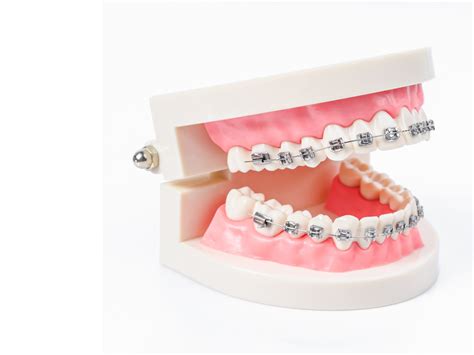 Metal Dental Braces - Victor Smiles - Victor, NY