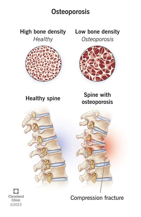 Osteoporosis: Symptoms, Causes And Treatment, 51% OFF