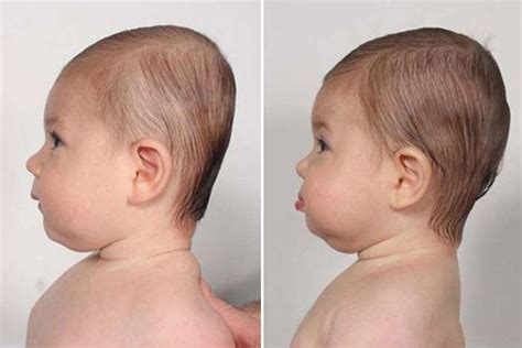 The Ins and Outs of Flat Head Syndrome in Babies