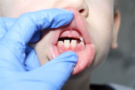 A Dentist Examines the Baby Teeth in the Boy. the Loss of Milk Teeth Stock Image - Image of milk ...