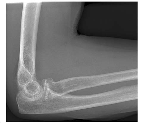 associated injury (coronoid fracture) on radiograph | Download Scientific Diagram