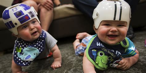 3D printed helmet aids babies healing from flat head syndrome | Braceworks Custom Orthotics