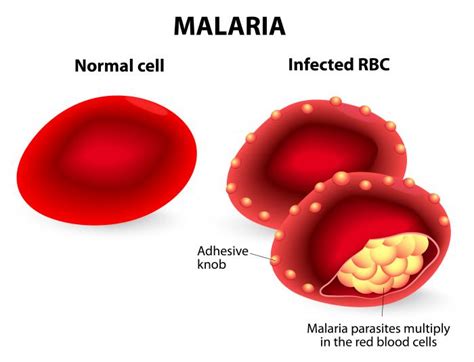 Malaria Causes Symptoms Prevention And Life Cycle Of Parasite