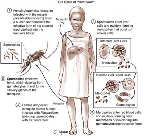 Malaria Infectious Diseases JAMA The JAMA Network