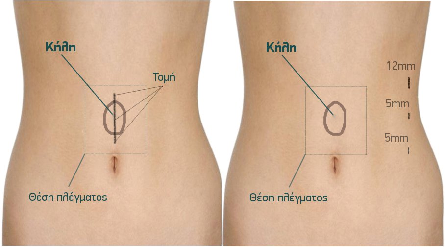 Συγκριτική απεικόνιση ανοικτής (ΔΕ) και λαπαροσκοπικής/ρομποτικής (ΑΡ) αποκατάστασης κοιλικήλης μέσης γραμμής