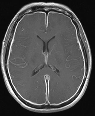 <span class="mw-page-title-main">Herpes meningitis</span> Medical condition