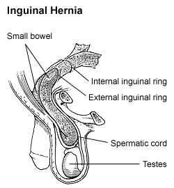 <span class="mw-page-title-main">Inguinal hernia</span> Medical condition in which contents of the abdominal cavity protrude through the inguinal canal