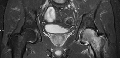 STIR MRI of transient osteoporosis.jpg