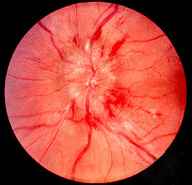 <span class="mw-page-title-main">Papilledema</span> Eye disorder