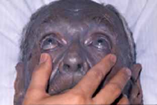 Argyria Medical condition