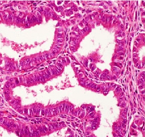 <span class="mw-page-title-main">Endometrioid tumor</span> Medical condition